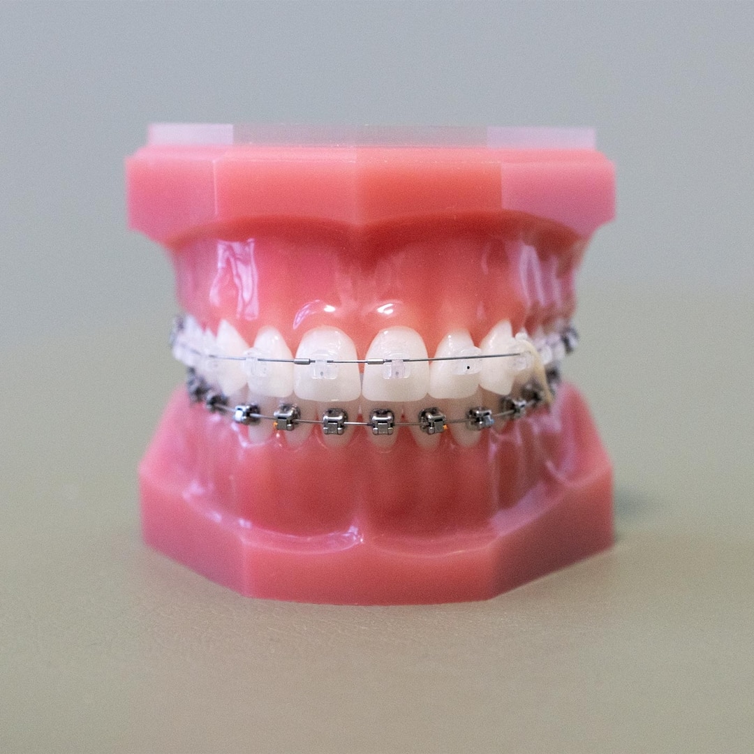 Multibracketapparatur mit Damon-Ultima-Brackets